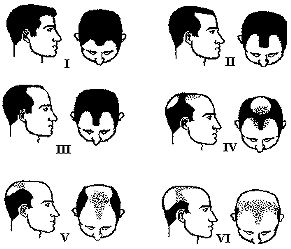 hamilton hair loss